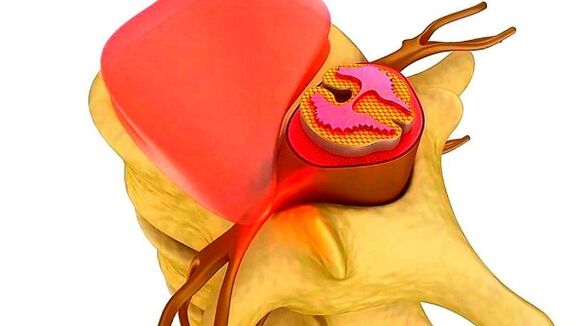 Chest spine osteochondrosis is the essence of the disease