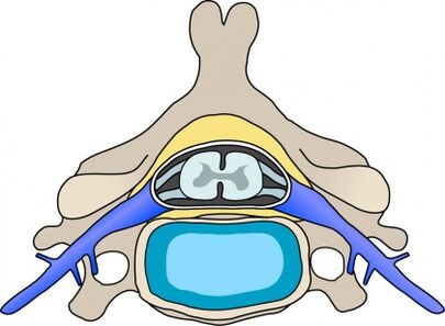 Protabius in the vertebra cervical with osteochondrosis